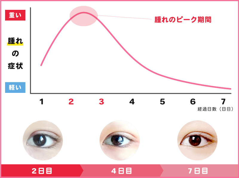 チェルアイズ　二重整形　腫れの症状と腫れのピーク 経過期間1日〜7日